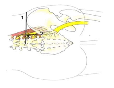 Lumbar Plexus Block