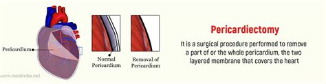 Pericardiectomy - Indications, Preparation, Procedure, Recovery & Complications