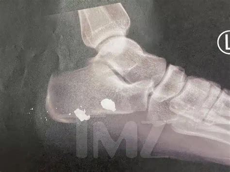 New Photos Show Megan Thee Stallion’s Foot Injury After Shooting