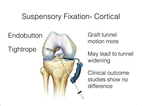 Acl graft fixation options