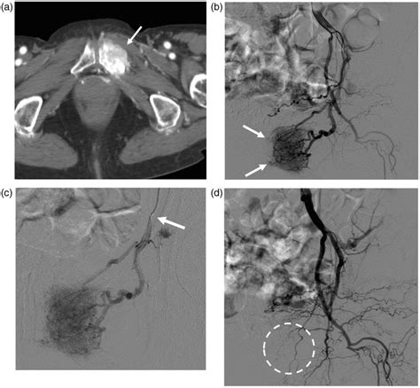 A 72-year-old women with renal cell carcinoma metastasis at the left... | Download Scientific ...