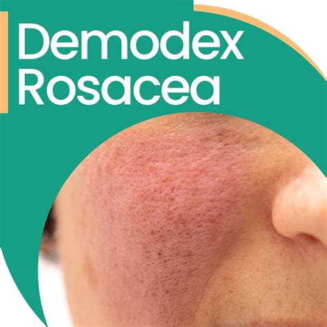 _ How to treat Demodex rosacea? . _ Ungex aims to eliminate mites with ...