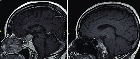 Pituitary adenoma: (a) Preoperative sagittal magnetic resonance imaging ...