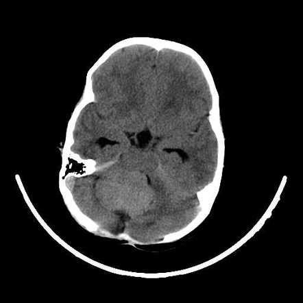 Medulloblastoma CT - wikidoc