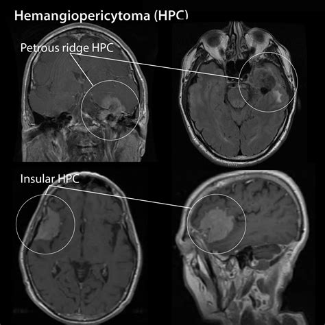 Clinical Pathology Glossary: Hemangiopericytoma | ditki medical & biological sciences