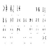 G-banded Female Karyotype 46,XX,inv(5)(p15q13) | Download Scientific ...