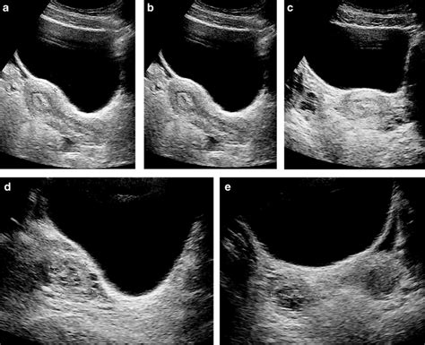 Selected images from a transabdominal pelvic ultrasound examination in... | Download Scientific ...