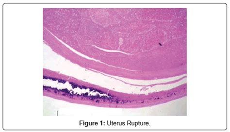 Spontaneous Uterus Rupture in the Post-partum