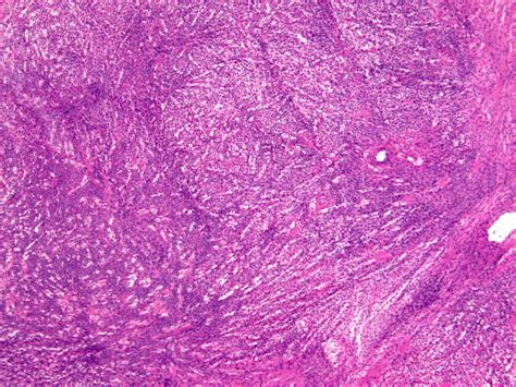 Ovarian Fibroma Histology