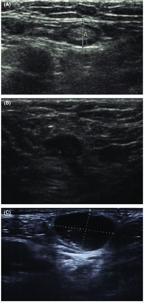 Swollen Lymph Nodes In Groin Women