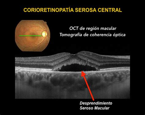 Coroidopatía Serosa Central | Somos Retina y Mácula Consultores