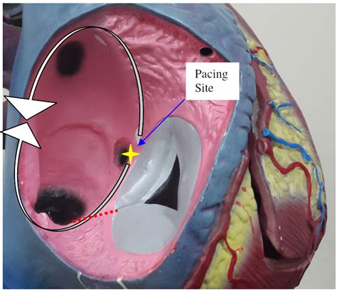 Atrial Flutter — Diagnosis, Management and Treatment | IntechOpen