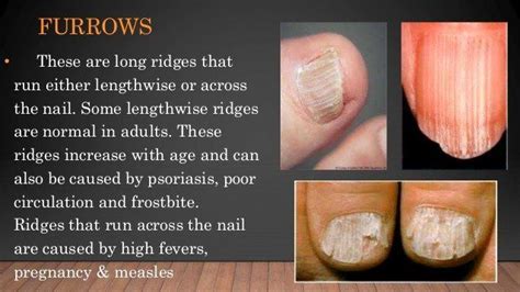 Nail Diseases and Disorders Awesome Nail Diseases and Disorders | Nail diseases and disorders ...