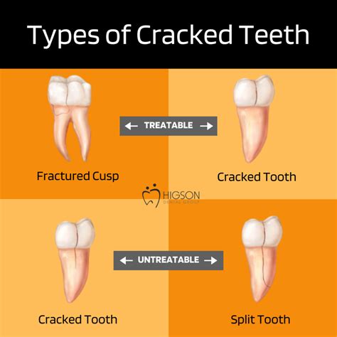 Cracked Tooth Repair - Common Causes and Fixes For Cracked Teeth ...