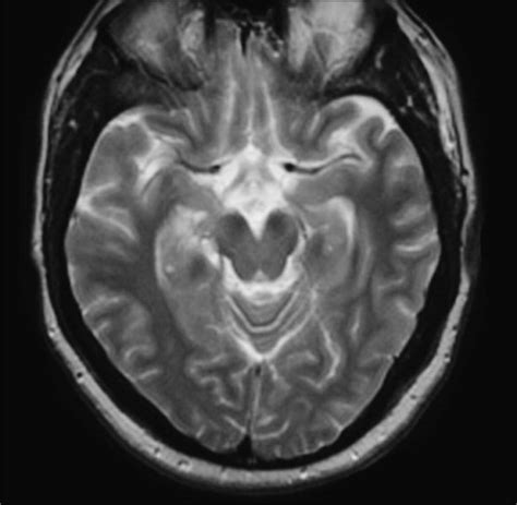 Normal Axial midbrain