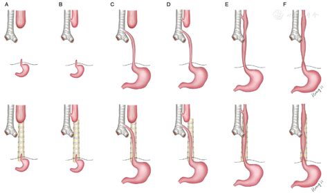 Detail correction for Gross classification of esophageal atresia based on 434 cases in China ...