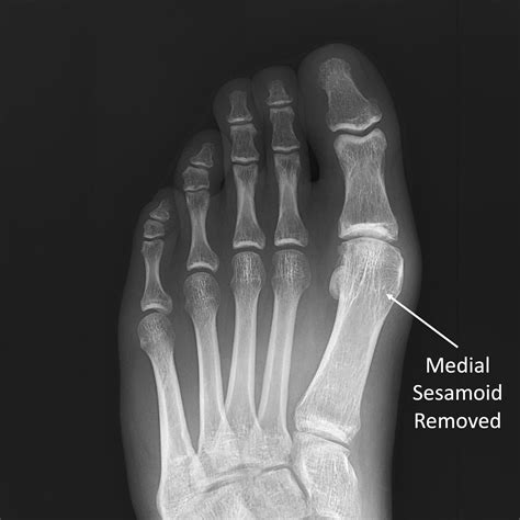 Sesamoid Bone Fracture