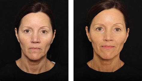 Thermage Before And After Photos Face (12) » Facelift: Info, Prices, Photos, Reviews, Q&A