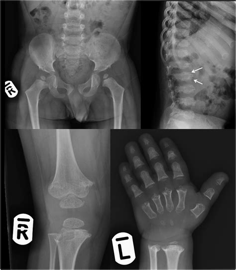 Skeletal Dysplasia