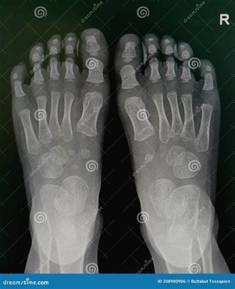 X-ray Image, Both Foot AP View, Show Normal Pediatric Bone. Stock Photo - Image of foot, normal ...