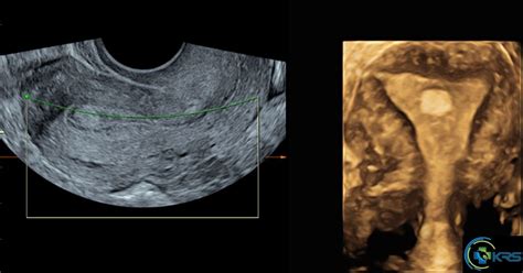 Endometrial polyp – 3D VCI - drkalirajanscans