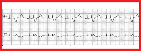 Float Nurse: Basic EKG Rhythm Test 23