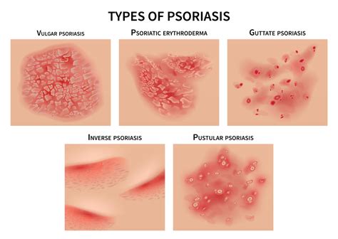 Psoriasis: Symptoms, Causes & Treatment - Affiliated Dermatology