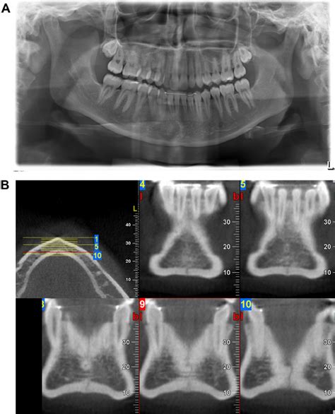 ( A ) Fracture of the mandibular symphysis not seen before on the ...