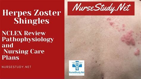 Herpes Zoster Shingles Nursing Care Plans and Diagnosis Interventions - NurseStudy.Net