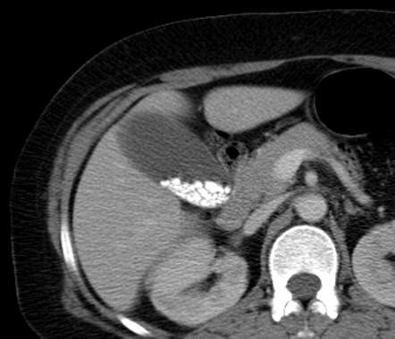 Gallstones | Radiology Reference Article | Radiopaedia.org