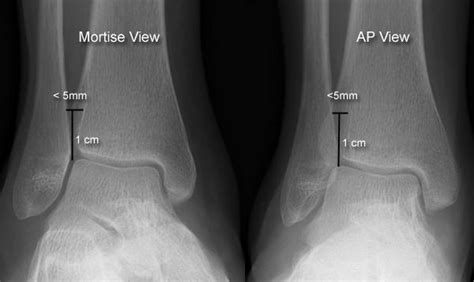 Ankle Fractures - Trauma - Orthobullets