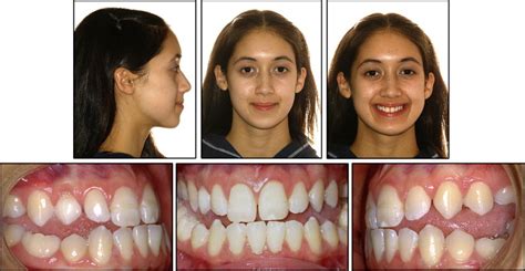 Nonsurgical treatment of a Class III patient with a lateral open-bite malocclusion | Pocket ...