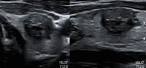 Papillary Thyroid Cancer Ultrasound