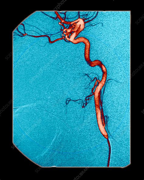 Internal Carotid Artery, Angiogram - Stock Image - C007/5815 - Science ...