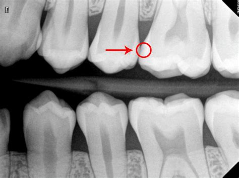 What Does a Cavity Look Like on an X-Ray? - Web DMD