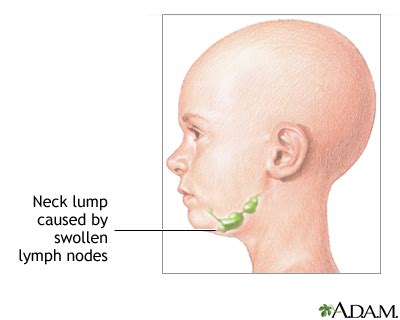 Neck lump | UF Health, University of Florida Health