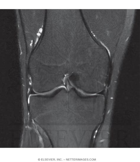 Coronal T2 MRI of the Knee Joint