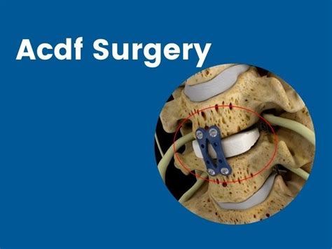 Acdf Surgery in Mumbai at best price in Mumbai | ID: 25850183248