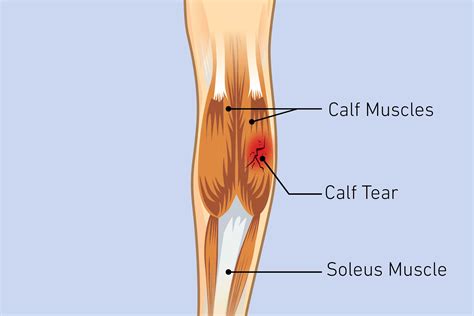 Calf Pain: Causes, Diagnosis, and Treatment | The Healthy