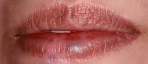 Venous Lakes Lip Laser Treatment in Phoenix, AZ - Atrium Dental