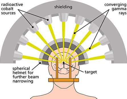 Gamma Knife Surgery - Healthtips by TeleMe