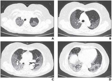 CT scans of coronavirus patients reveal nature and extent of lung damage