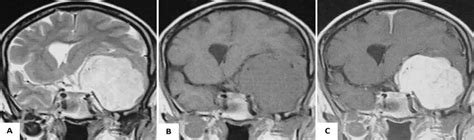 Case 1.Sphenoid ridge meningioma; (A-C) coronal T2, T1 and post... | Download Scientific Diagram