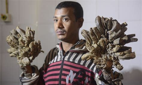 ‘Tree Man’ Set For Life-Changing Surgery In Bangladesh