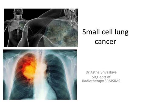 Small Cell Lung Cancer