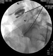 Understanding Medical Tests: Diagnostic Spinal Injections