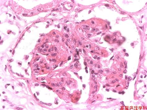 KMU Pathology Lab《Slide 125.》Benign nephrosclerosis with malignant change, Kidney