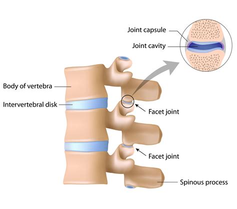 Facet Joint Syndrome | Pacific Sports & Spine