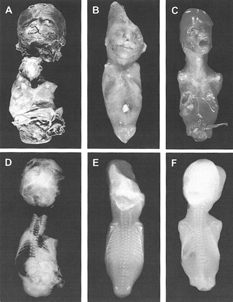 Homozygous WNT3 Mutation Causes Tetra-Amelia in a Large Consanguineous ...