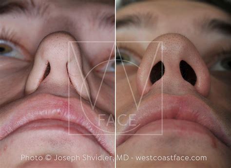 Nasal Valve Collapse - West Coast Face